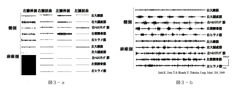 完全片麻痺の症例　両下肢走行